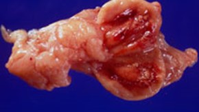 Uppklippt bursa Fabricii från en kyckling med vvIBDV-infektion. I slemhinnan ses blödningar och tecken på celldöd (nekros).