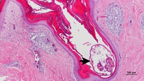 Mikroskopisk bild på kvalsterangripen hud hos en höna